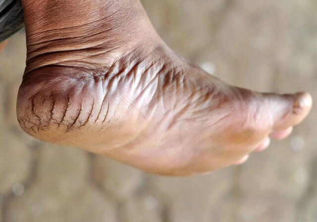 Close-up of dry, cracked skin on the heel of a foot