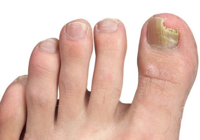 Close-up of toenails with fungal infection, showing discoloration