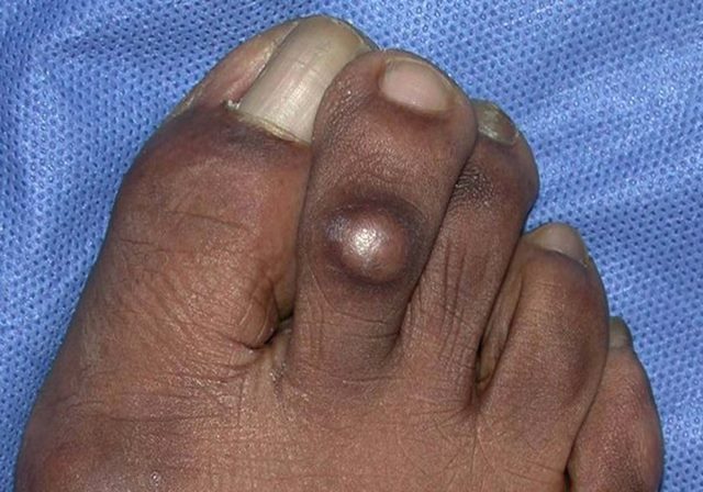 Foot with visible hard corns and calluses on the skin