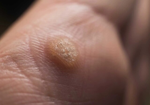 Close-up of a foot with a visible verruca (wart) on the sole