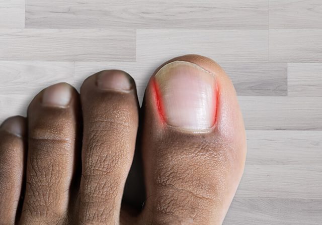 Close-up of a toe with an ingrown toenail showing redness and inflammation