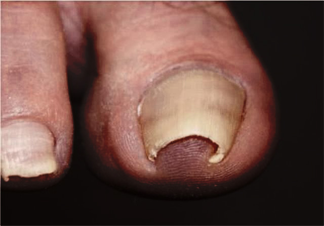 Close-up of a curved toenail causing skin irritation